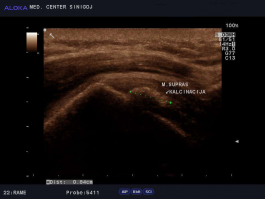 Ultrazvok rame - kalcinacija v tetivi supraspinatusa